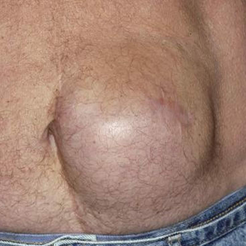 hernia hiatal ecuador